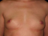 Patient # 76939 Before Photo # 1
